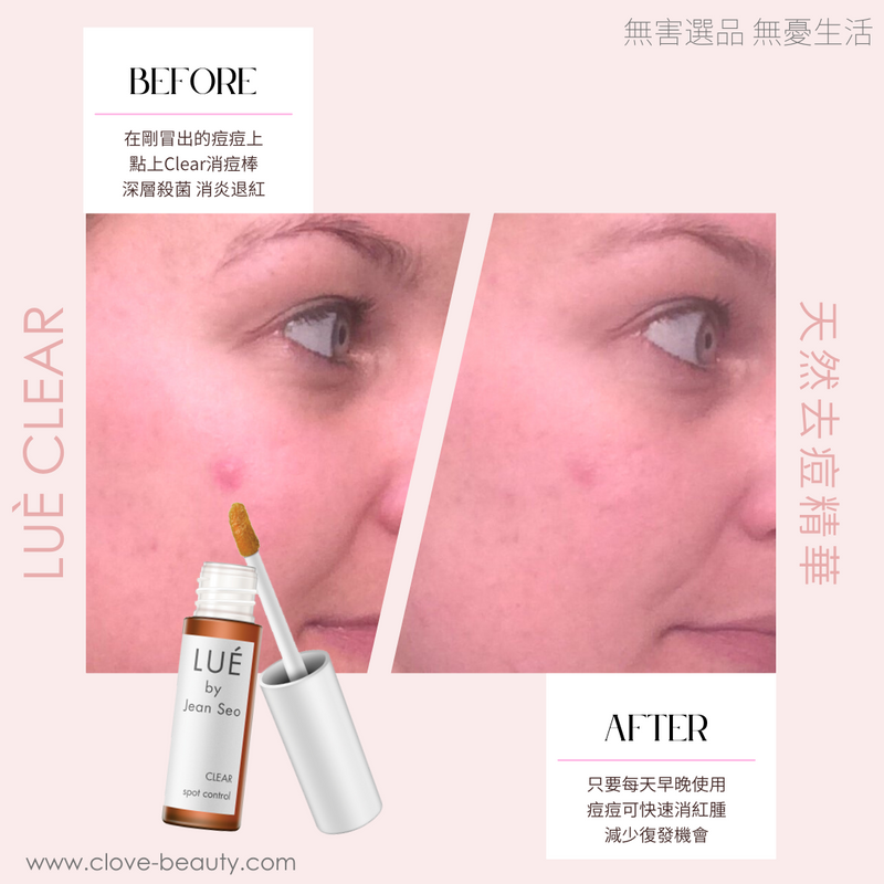 痘痘治療 (Acne treatment) 痘痘產品 (Acne products) 痘痘膏 (Acne cream) 痘痘解決方案 (Acne solution) 痘痘藥物 (Acne medication) 痘痘潔面乳 (Acne cleanser) 痘痘點膏 (Acne spot treatment) 痘痘凝膠 (Acne gel) 控制痘痘 (Acne control) 痘痘精華液 (Acne serum) 痘痘面膜 (Acne mask) 痘痘洗面乳 (Acne face wash) 痘痘護膚品 (Acne skincare)