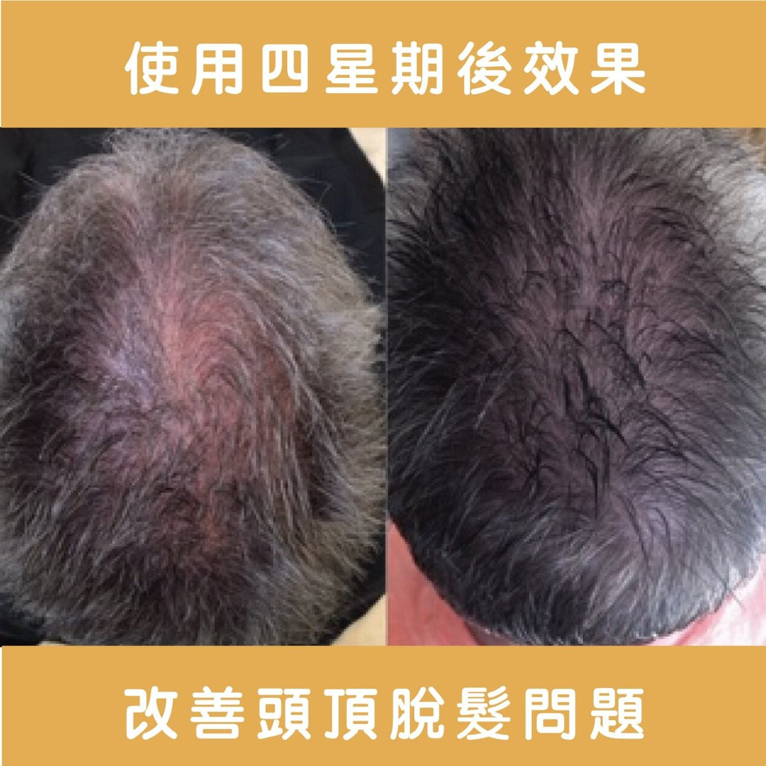 Ethica Corrective Set hair growth kit for men and women M字額救星 - Clove Beauty