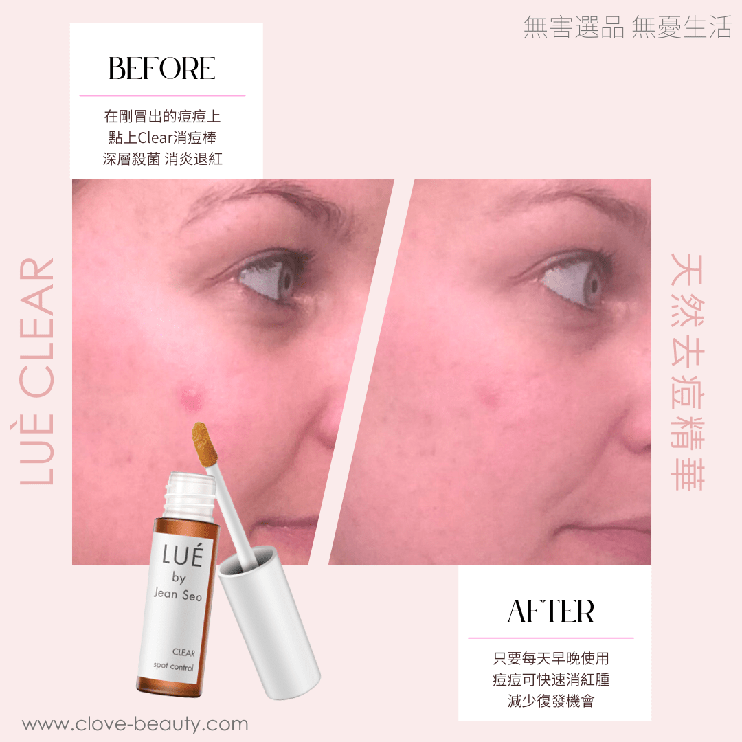 Best natural acne treatment kit Hong Kong 消炎去印套裝